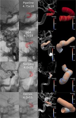 Cerebral Aneurysm Occlusion at 12-Month Follow-Up After Flow-Diverter Treatment: Statistical Modeling for V&V With Real-World Data